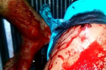 Uma das vítimas foi atingida na perna. (Foto: Jorge Santana / Sudoeste Bahia)