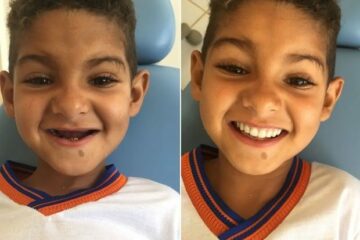 Aos seis anos, menino ganhou prótese e emocionou equipe médica (Foto: Amando Mattos/Arquivo Pessoal)