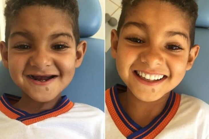 Aos seis anos, menino ganhou prótese e emocionou equipe médica (Foto: Amando Mattos/Arquivo Pessoal)