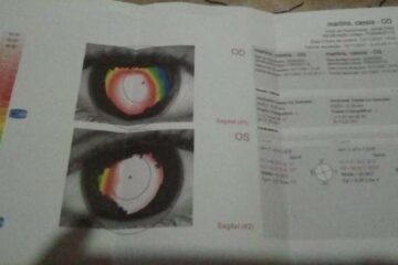Família malhadense pede ajuda para tratamento filha com Ceratocone.reprodução família.