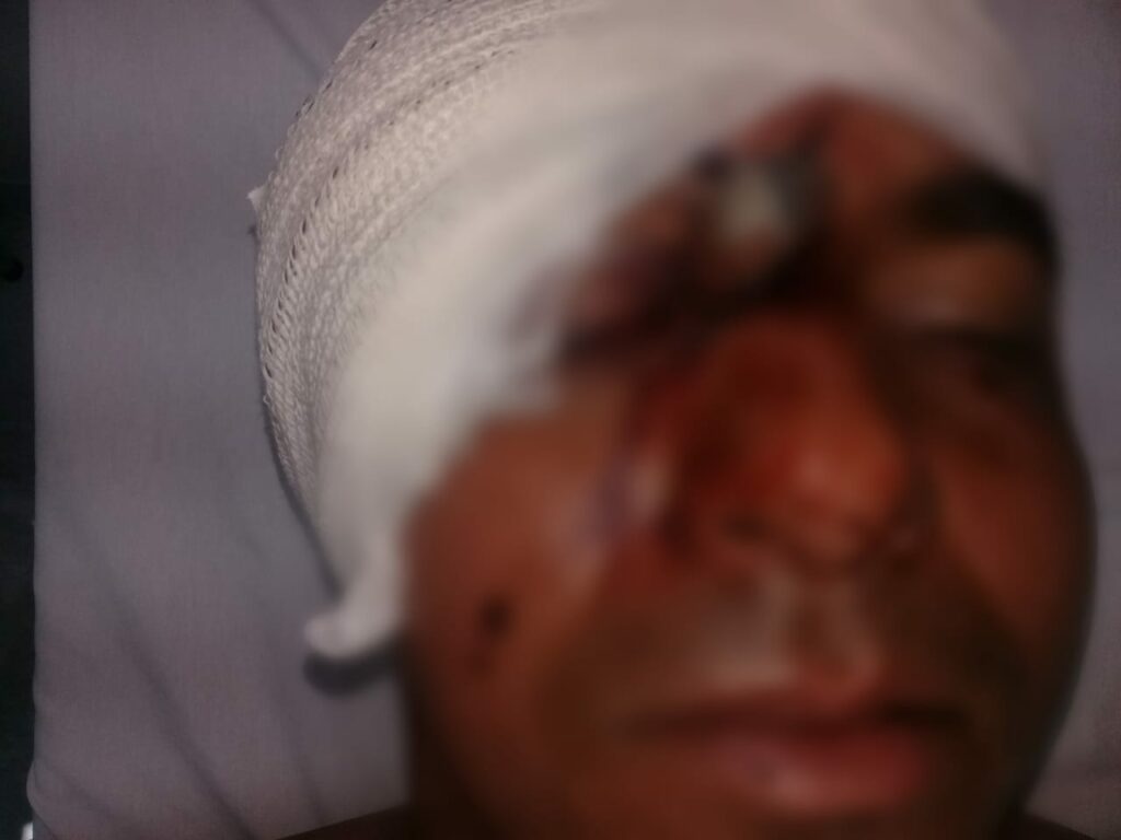 Marquinhos tem faca cravada no rosto após briga com irmão em Carinhanha. Foto: reprodução rede social