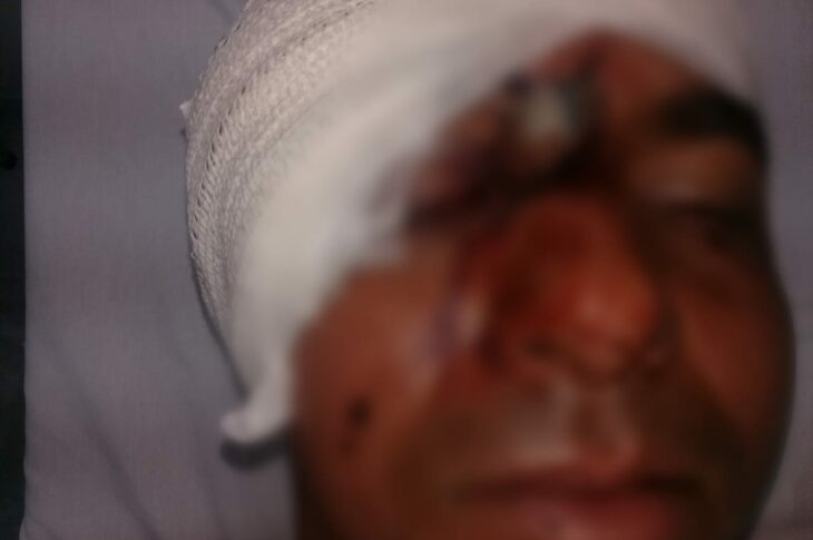 Marquinhos tem faca cravada no rosto após briga com irmão em Carinhanha. Foto: reprodução rede social