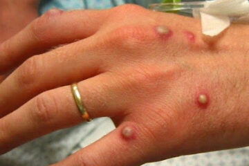 Varíola dos macacos. Foto: ilustrativa