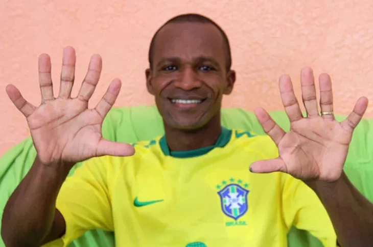 Josevaldo mostra mãos com seis dedos cada (Foto: Raimundo Mascarenhas / site Calila Notícias)