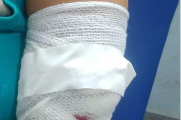 Braço da vítima na UPA. Foto: Reprodução Polícia Militar