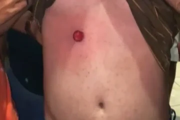 Lesão causada por disparo.Foto: WhatsApp/Achei Sudoeste